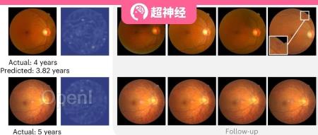 上海交大与清华联手发布DeepDR Plus，仅用眼底图像可预测5年内糖尿病视网膜病变进展（上交大和清北）